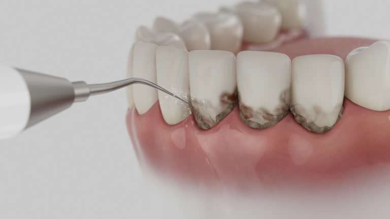 Trusted Invisalign Clear Aligners service in Lexington, KY - Dentist Open Now